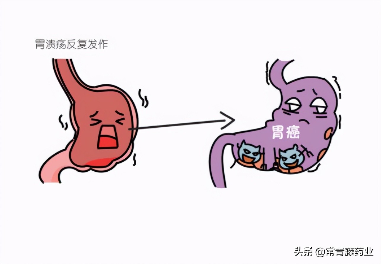 什么是胃癌早期有哪些症状,胃癌是怎么形成和症状