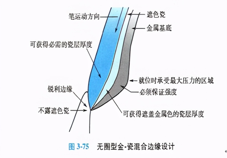 口腔金属冠与全瓷冠的区别,牙科医生讲义