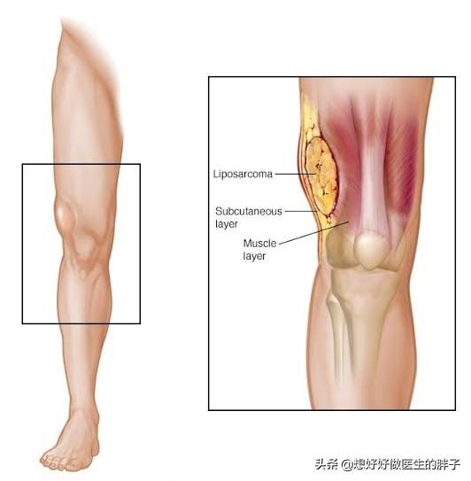脂肪瘤长得比较快是因为恶变了吗,长了一个脂肪瘤必须赶紧做手术吗