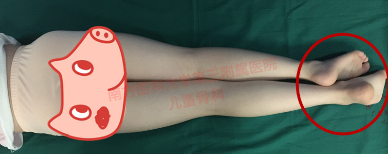 小孩髋关节疼痛导致长短腿,一岁髋关节发育不良长短腿o型腿