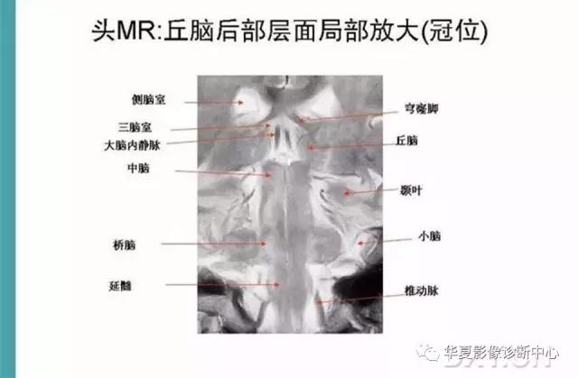mra头颅解剖学详细讲解视频,常见的头颅mri图像