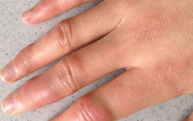 手指晨僵不是类风湿是什么手指晨僵该如何是好