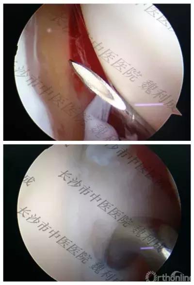 手腕囊肿抽吸出来后可否继续按压,足背囊肿穿刺好还是切除好