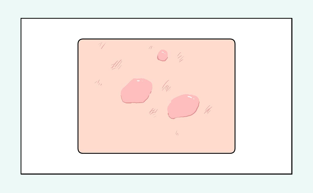 脸上的红疙瘩疼是什么原因,脸上的各种疙瘩