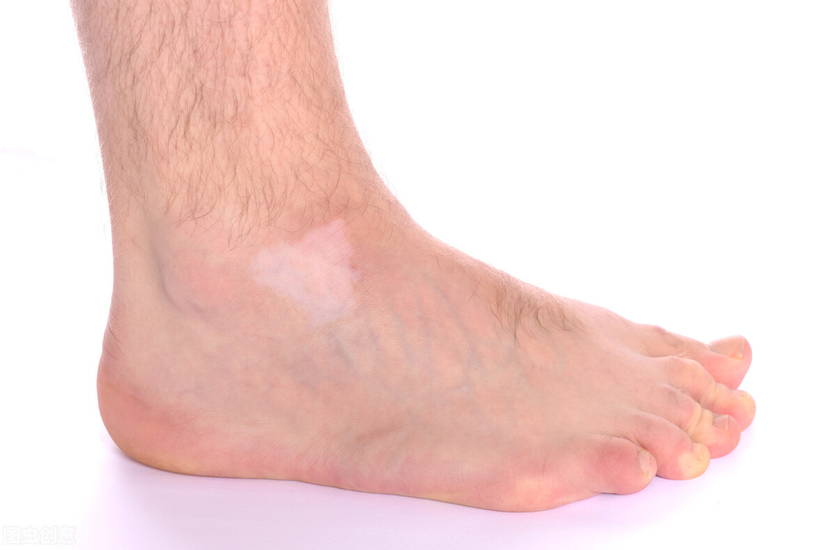 如何正确治疗患上白癜风？