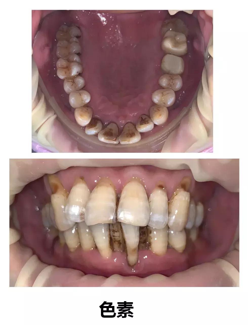 牙齿正面有小黑点千万不要忽视,不要小看牙齿的小黑点