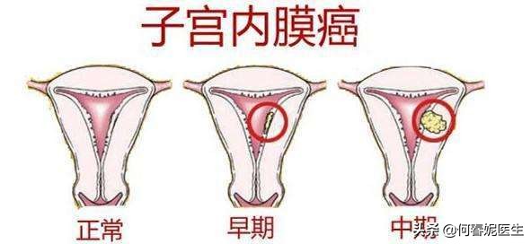 子宫内膜癌是不是子宫恶性肿瘤,子宫内膜癌高危