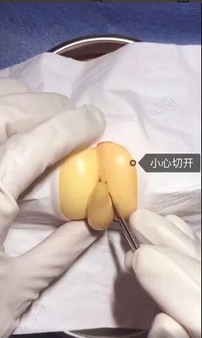 香蕉割包皮,洋葱剖腹产?这是我见过最秀的医生
