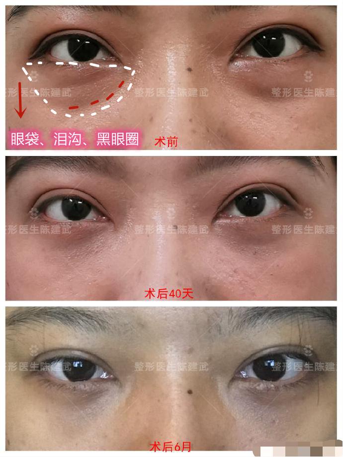 眼袋手术为什么不能侧睡,眼袋手术感觉眼睛闭不上