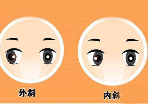 家长担心小孩近视加深,孩子近视会引起斜视吗