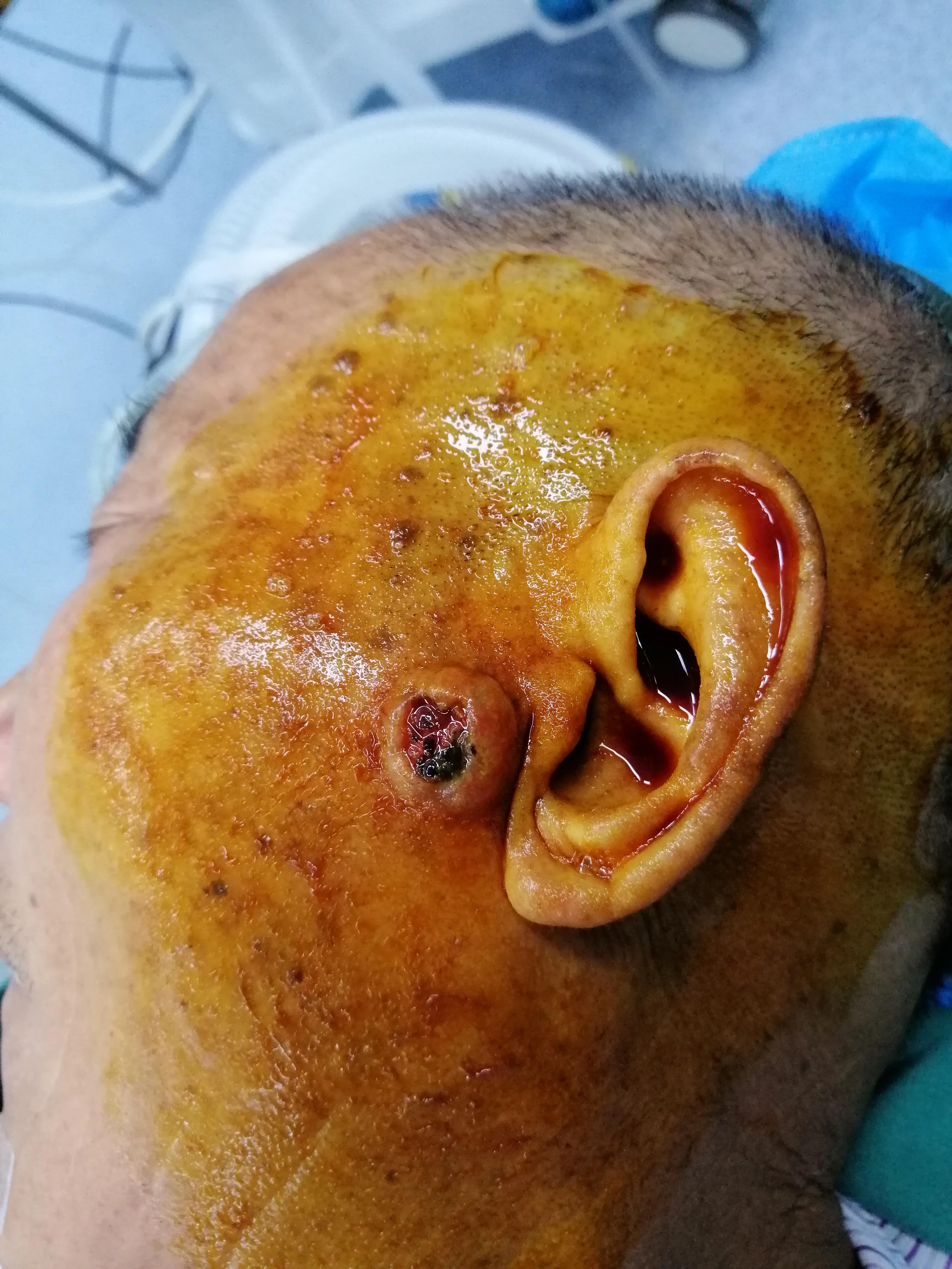 老人脸上出现肉疙瘩,脸上有个硬疙瘩手术切除