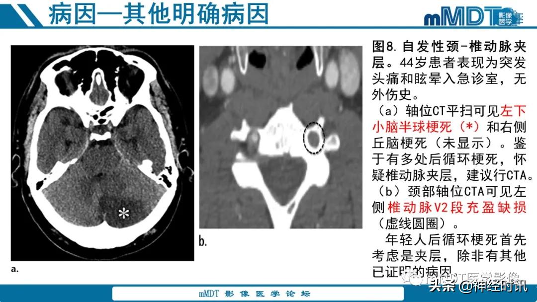 缺血性脑卒中护理课件,缺血性脑卒中讲课ppt