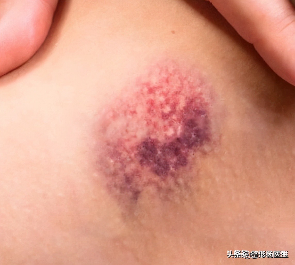 20岁面部凹陷如何改善,脂肪填充面部凹陷怎么导致的呢