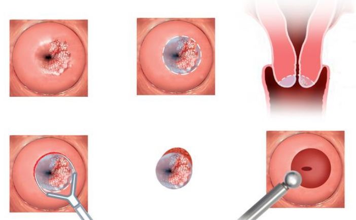 妇科医生建议：女性做好3件事，你才能真正预防好宫颈癌