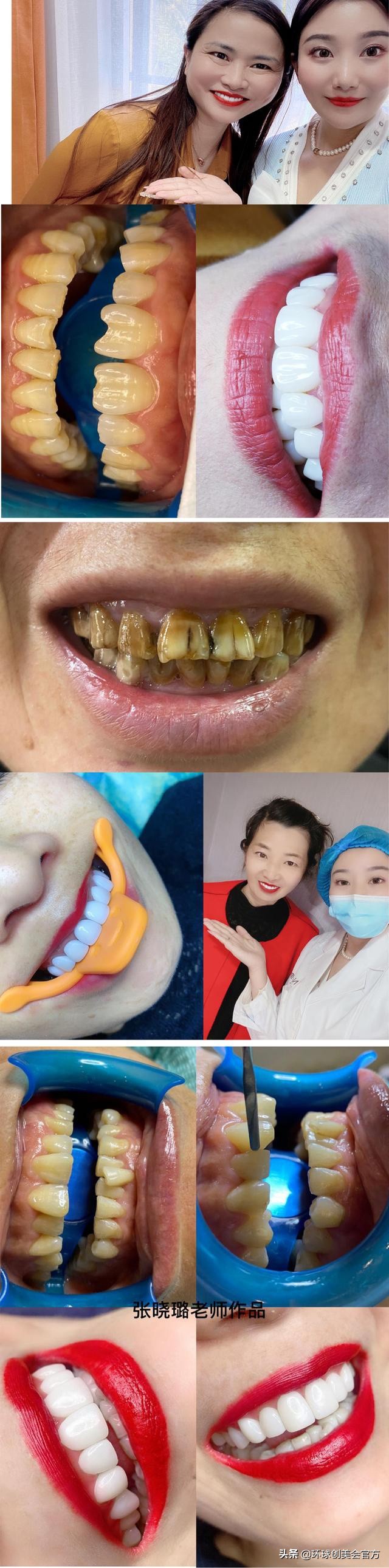 美牙艺术让世界增加更多灿烂笑容—国家高级口腔美学专家张晓璐