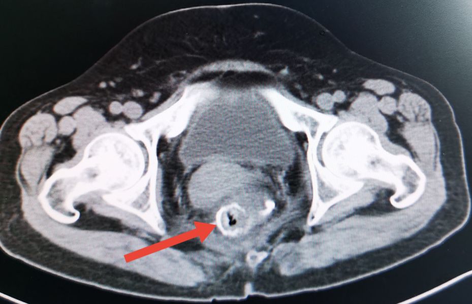 直肠癌术后造瘘口的预见性护理,直肠癌术后吻合口瘘护理措施