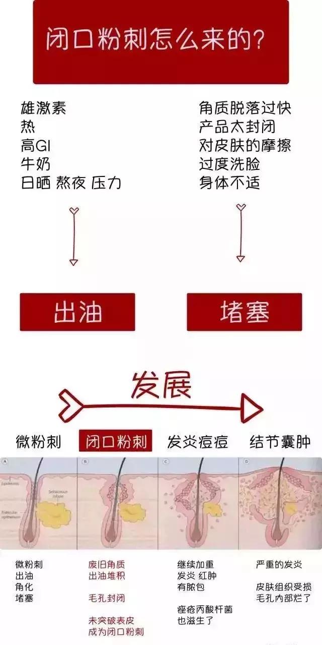 闭口粉刺痘痘黑头白头的区别,开口粉刺和闭口怎么区分