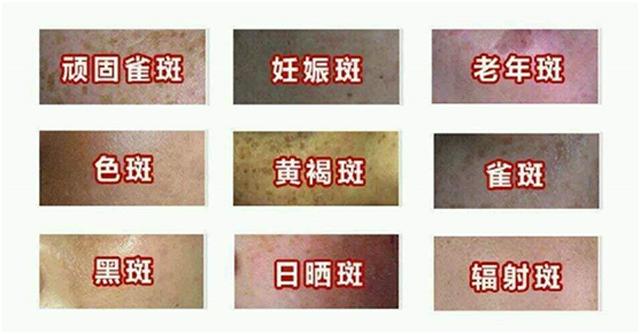 激光祛斑十五年以后再点斑可以吗,脸上长斑真的可以治好吗