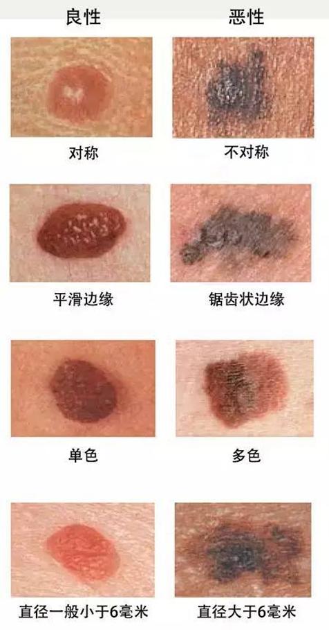 点痣得皮肤癌的几率多大,点痣点出皮肤癌