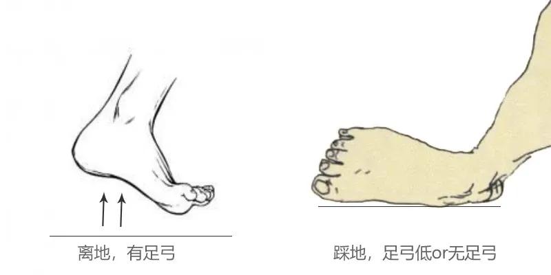 如何判断扁平足是先天还是后天,扁平足简单自测