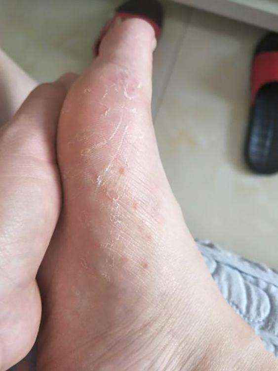 脚气各种症状都有,怎么样才是得了脚气的症状