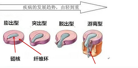 女性为什么会得腰间盘突出,女性腰椎间盘突出最佳锻炼方法