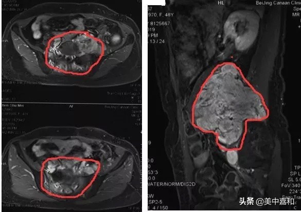 多发性血管瘤能自行消退吗,脑部血管瘤3年后复发最好的办法