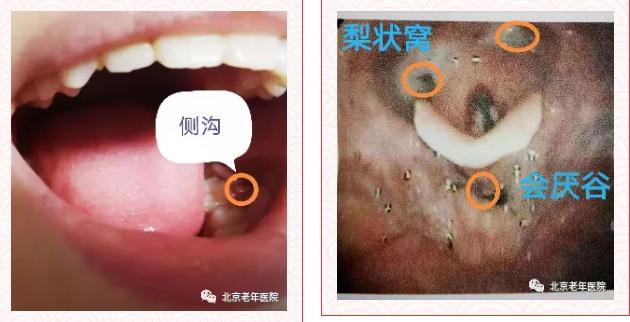 老年照护气道异物的应对流程,老年人厌食急救最新方法