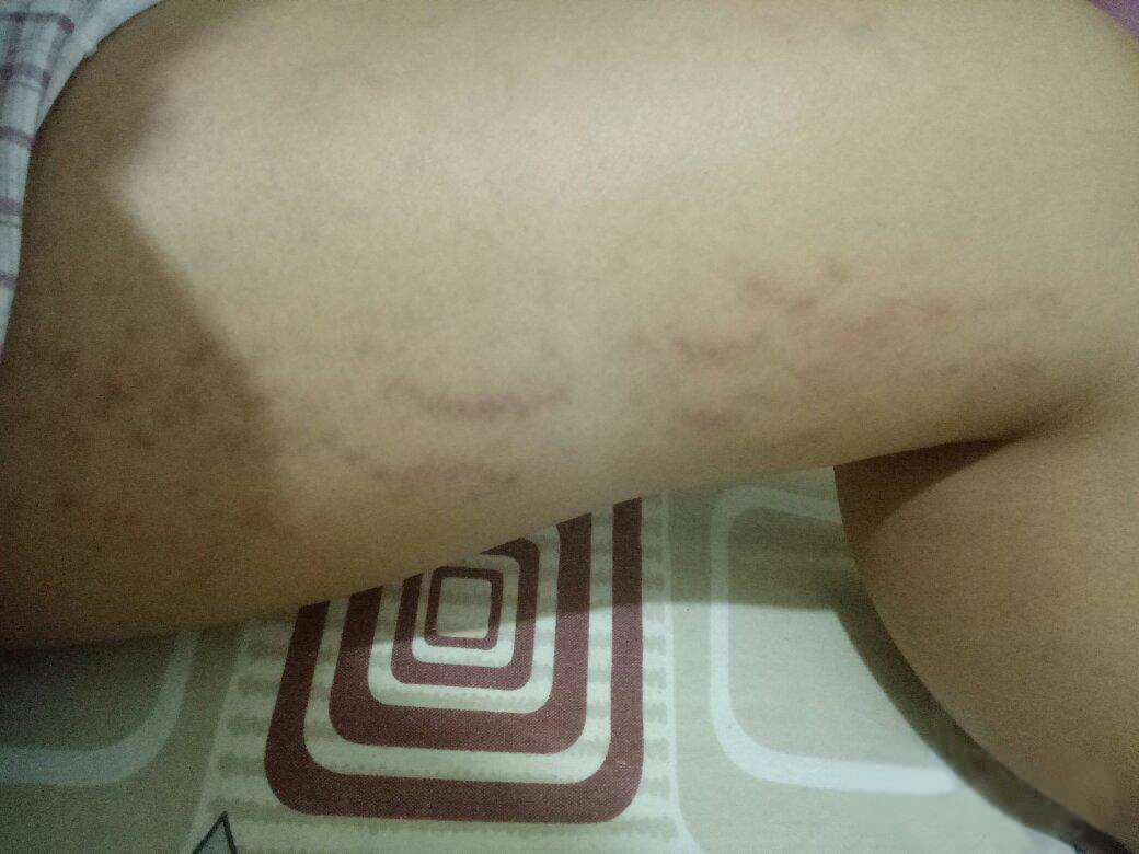 日本预防妊娠纹最好的产品,预防妊娠纹最好产品排名前十