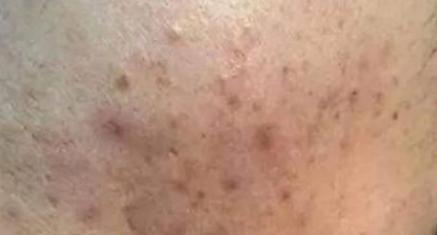 脸上痘印多久会自行消失,在脸上挤痘痘留下的痘印会消失吗