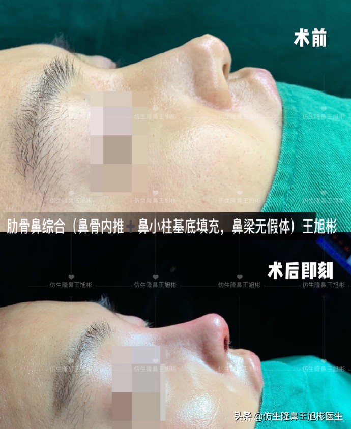 鼻中隔重塑鼻头,鼻中隔重建整形