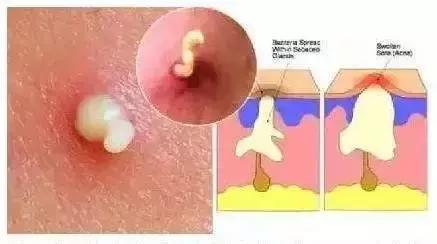 痘痘里面的白脓，是挤还是不挤呢？