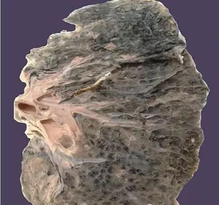 肺纤维化是慢性疾病吗,不是癌症不能治愈的病