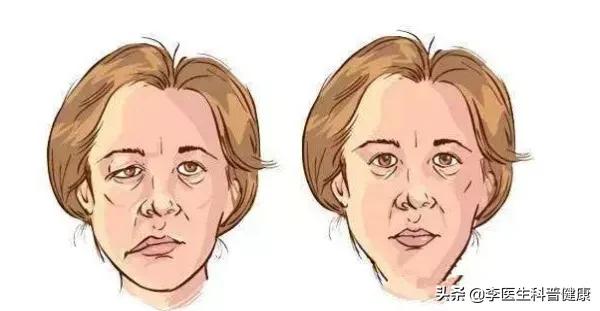 面部吹点冷风，发现眼睛闭不上了，嘴巴也歪了，到底是咋回事儿？