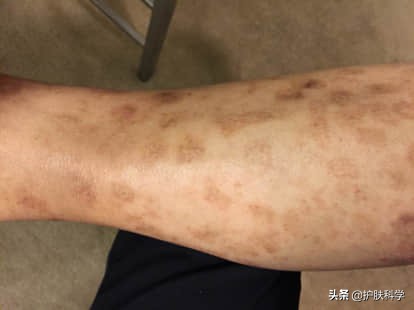 脸上长斑怎么办教你一个小妙招,脸上有斑怎么消除黑斑