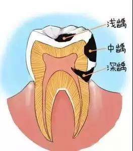 为啥补牙不能一次完成?补牙后怎么还牙疼?没选对医生吗?