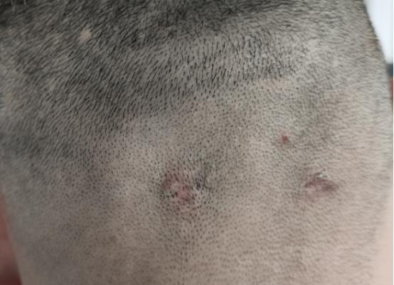 着急上火起疙瘩,着急上火脖子肿胀怎么回事