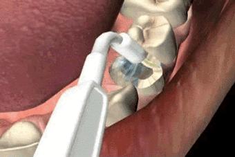 上火牙齿松动一咬就疼吃什么药,上火牙齿松动发软用什么药