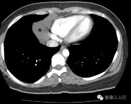 纵隔囊肿影像学表现,纵隔囊肿心包囊肿