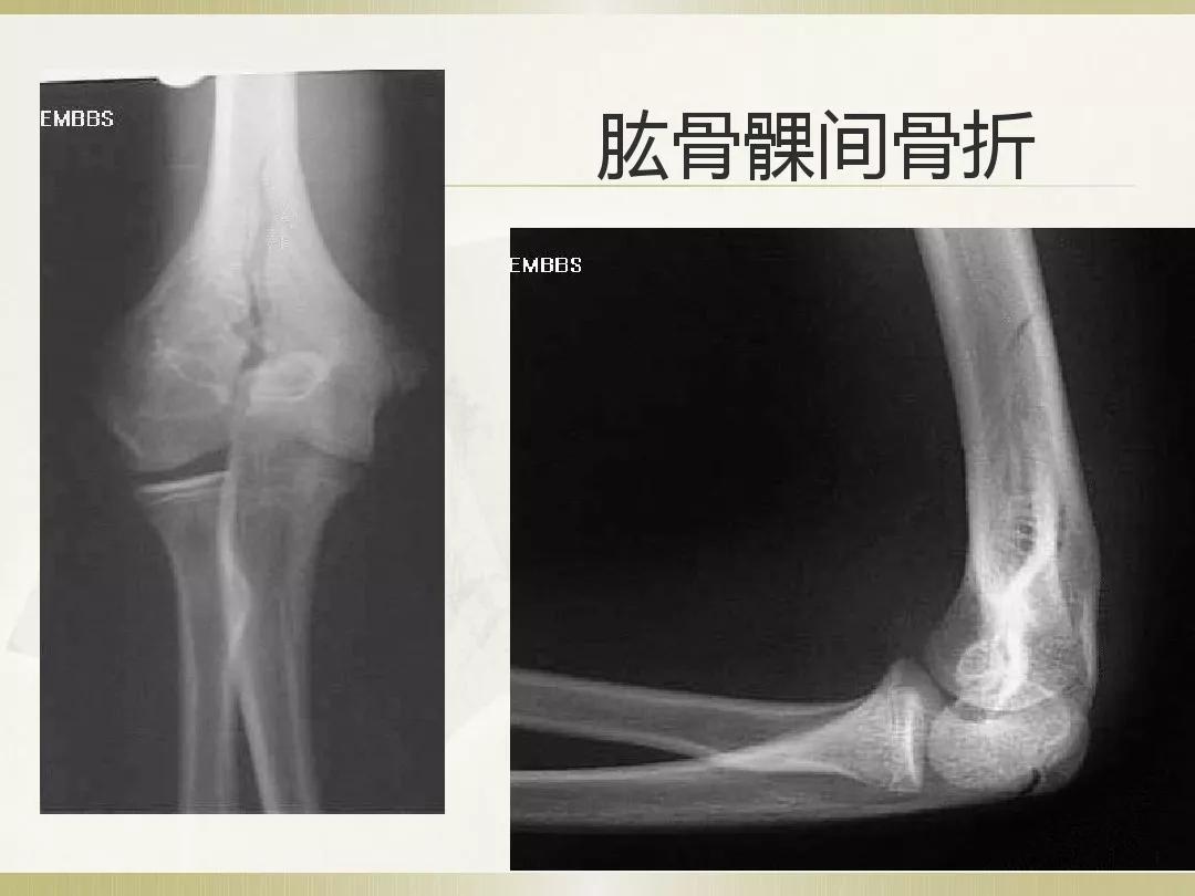 骨科x光片读片技巧,放射科骨科读片教程