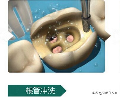 根管治疗后树脂填充还是戴牙冠好,根管治疗后的牙不疼用拔掉吗