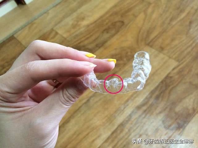 钢牙套矫正的全过程,牙齿稀疏矫正适合隐形还是钢牙套