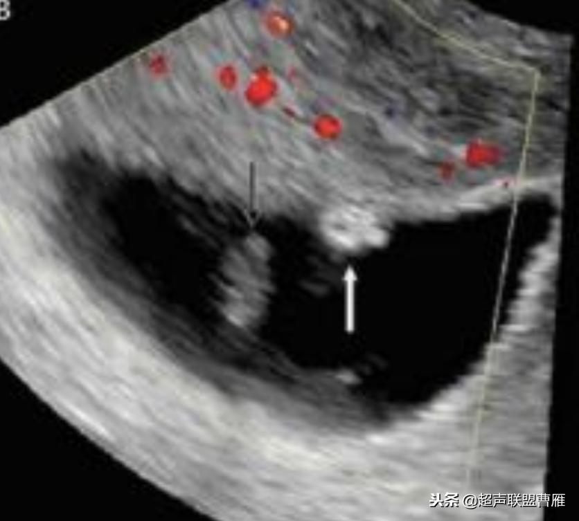 内见卵黄囊,卵黄囊肿瘤