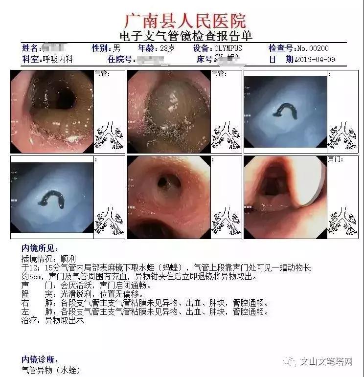 吓人!广南一男子气管内发现6厘米蚂蟥,文山人注意了……