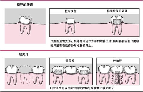 单颗牙缺失搭桥牢固吗,单颗槽牙缺失修复选用哪种方法好