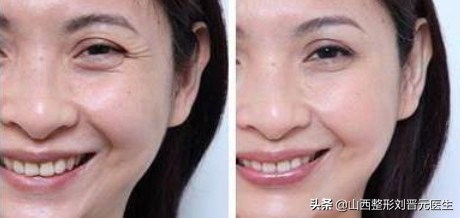 先改善细纹还是先修复抗衰,眼部显老怎么做抗衰