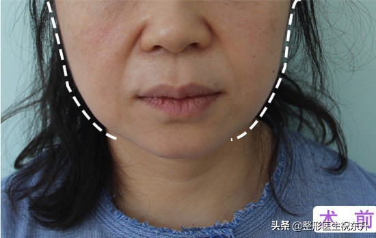 法令纹松弛脸颊下垂怎么填充,用什么来填充法令纹是最好的