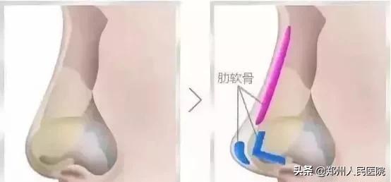 鼻子变好看的方法速成,让鼻子变好看图集