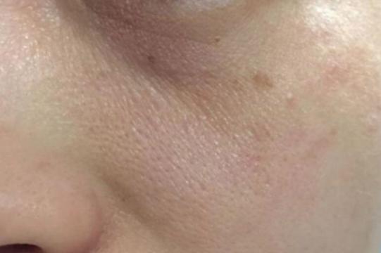 打败毛孔!下一个反孔精英就是你!