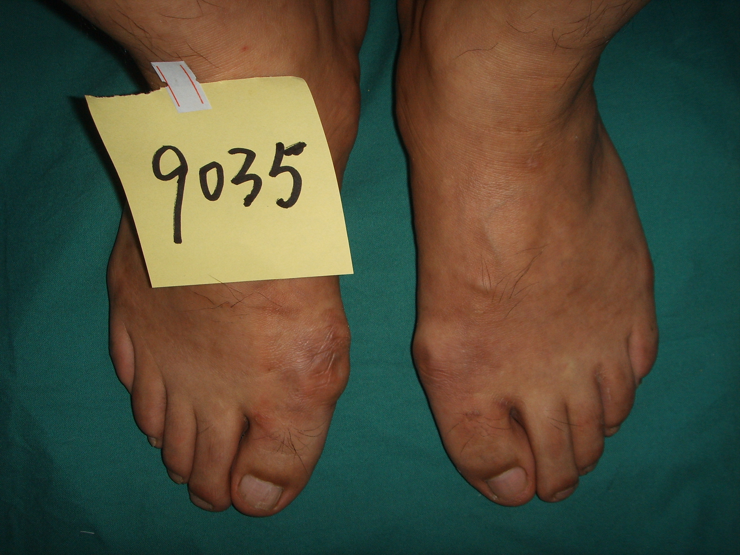 20岁男拇外翻,年轻小伙子拇外翻好大